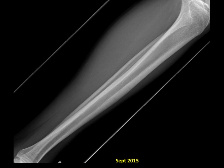 Figure 2 for case stress fracture ( RID4695 )